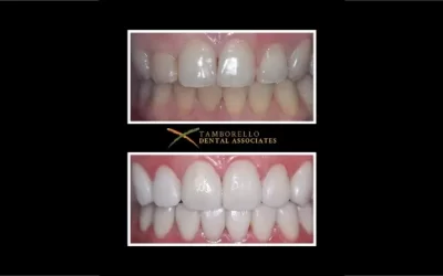 Transforming Smiles: Veneers Before & After