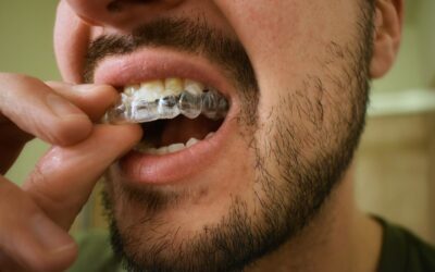 Benefits of Custom-Fit Mouth Guards