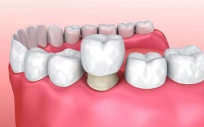 What does a dental crown look like?